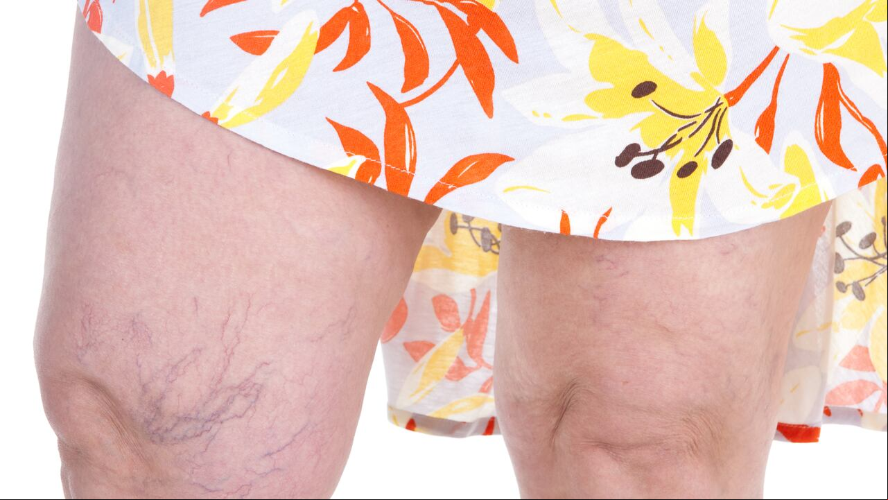Varices