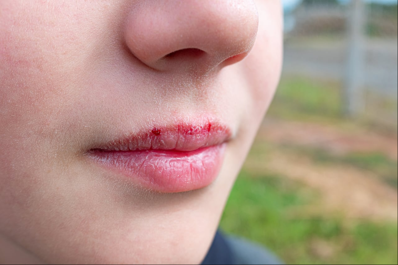 labios agrietados