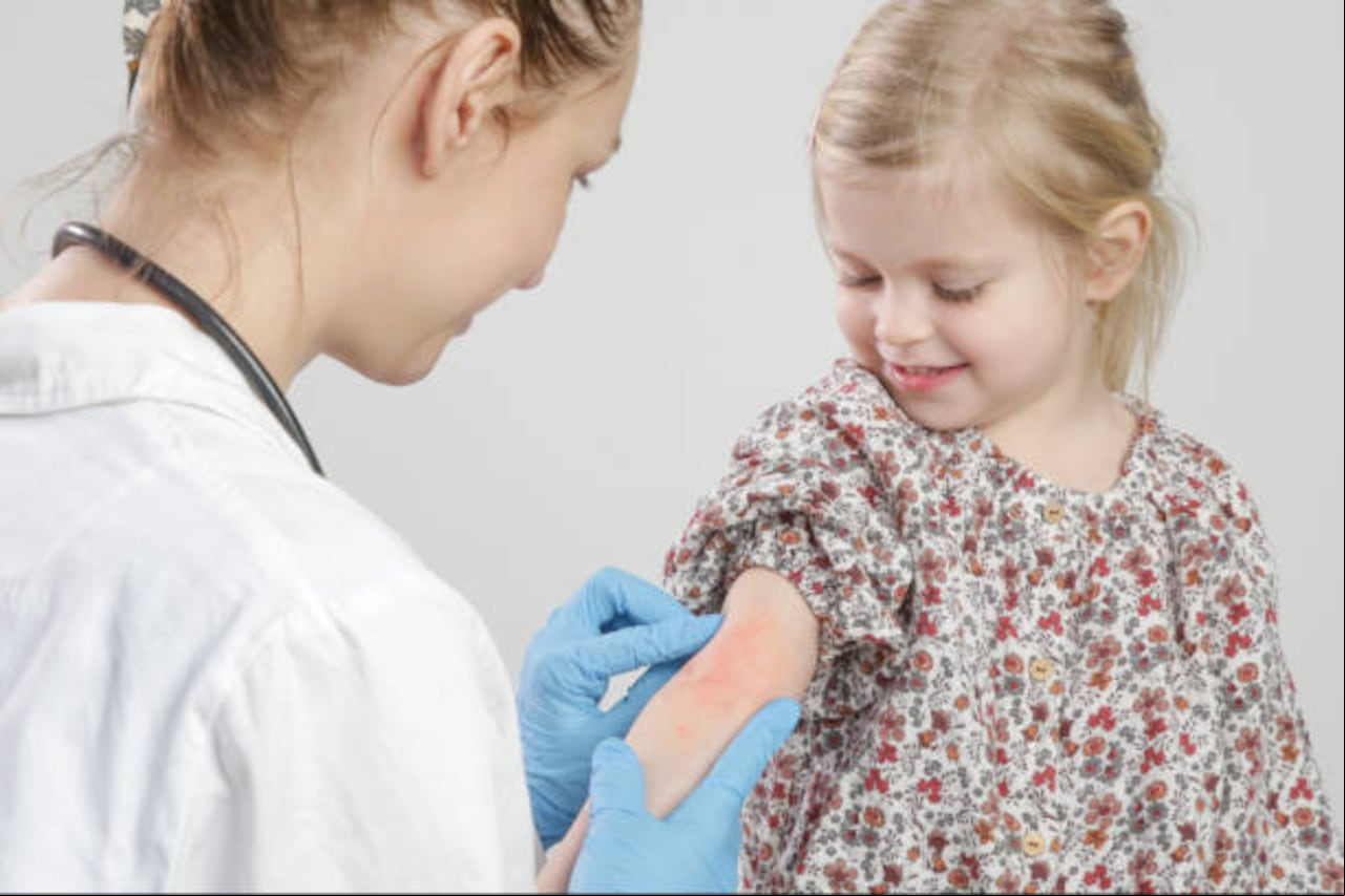 La marcha atópica es un concepto que describe la progresión de la enfermedad inflamatoria tipo 2 en pacientes pediátricos y, según evidencia científica, esta patología inicia con la aparición de la dermatitis atópica, para luego dar paso a otras enfermedades como la rinitis y el asma.