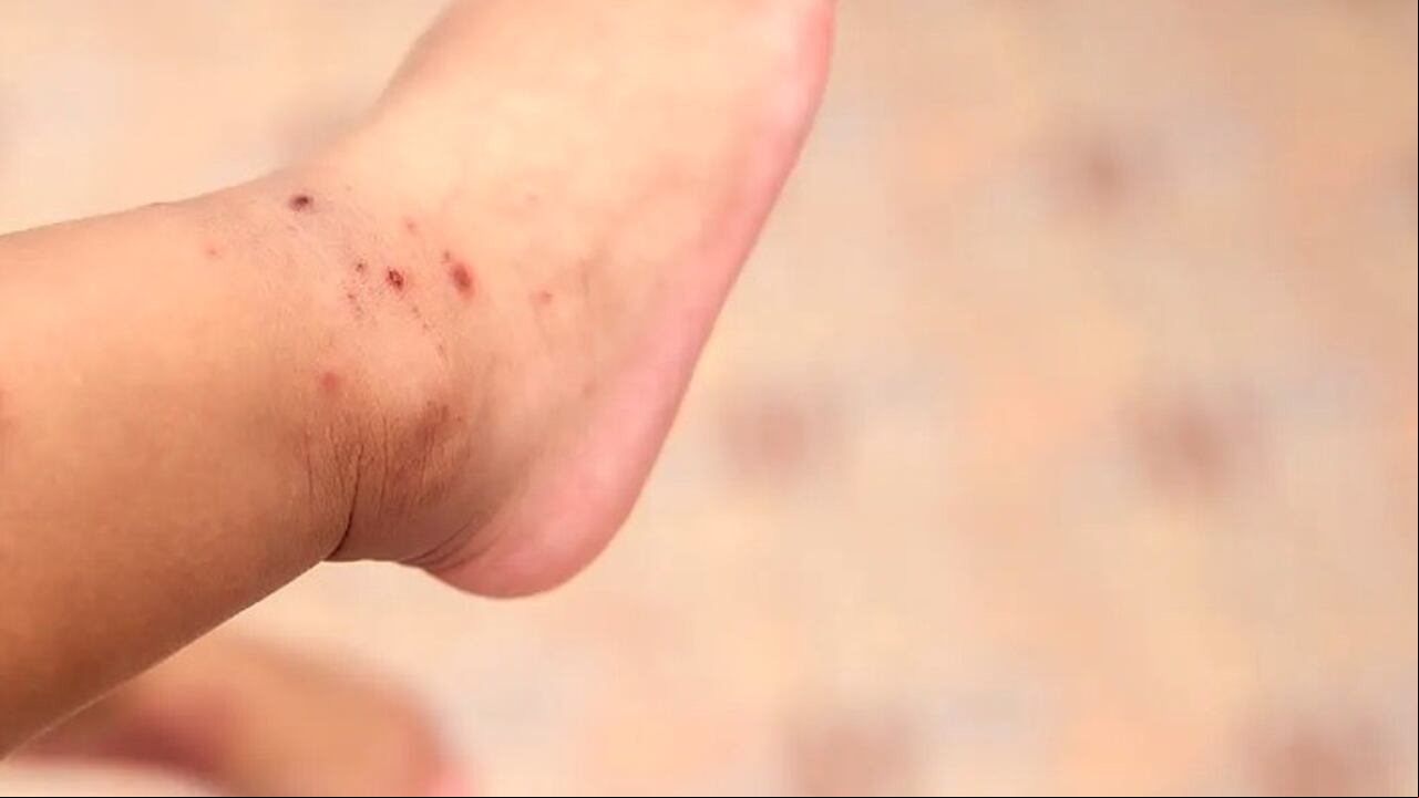Para tranquilidad de los mayores esta infección es benigna