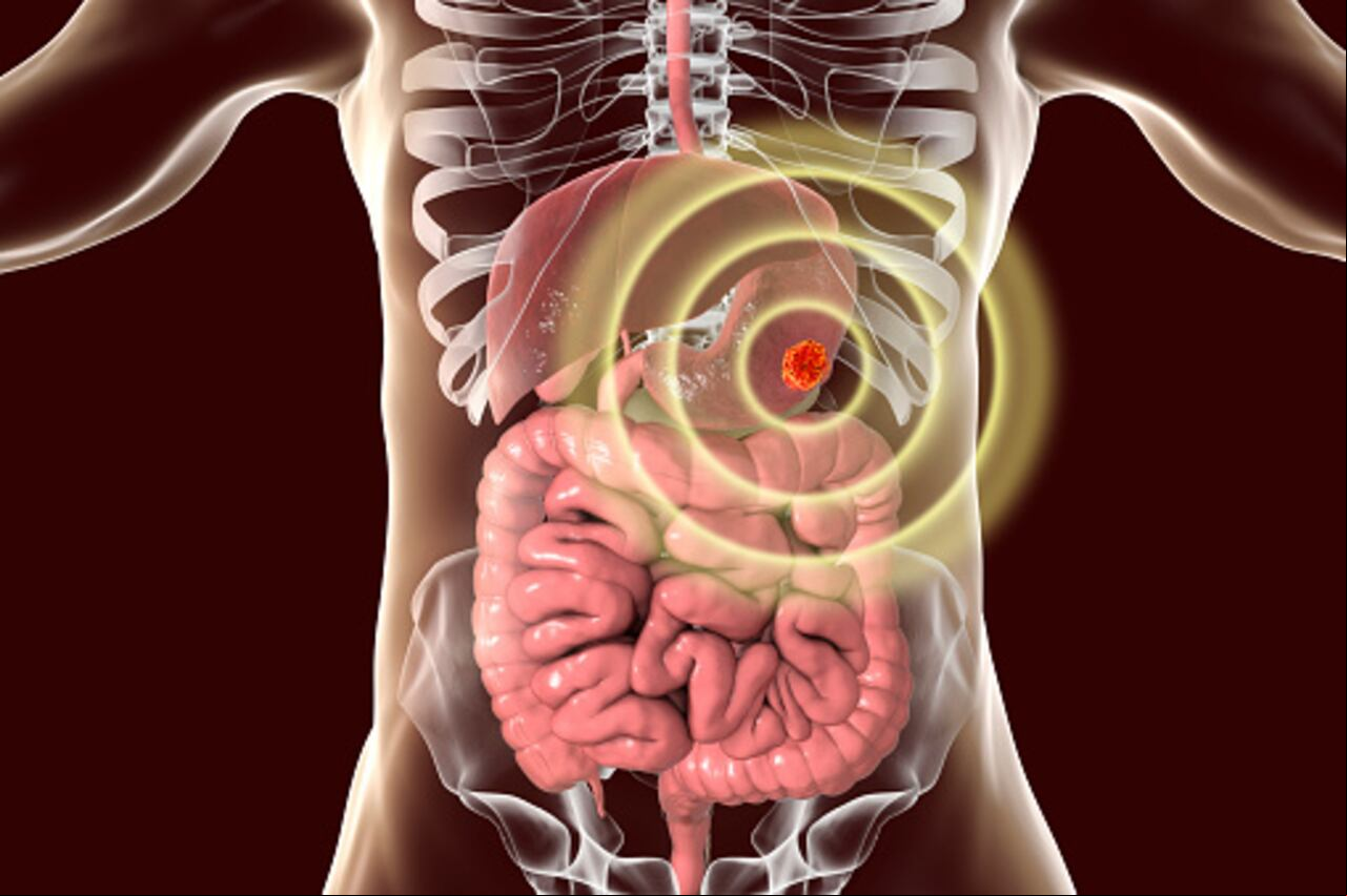 El cáncer de estómago empieza cuando las células en este órgano crecen de manera descontrolada.