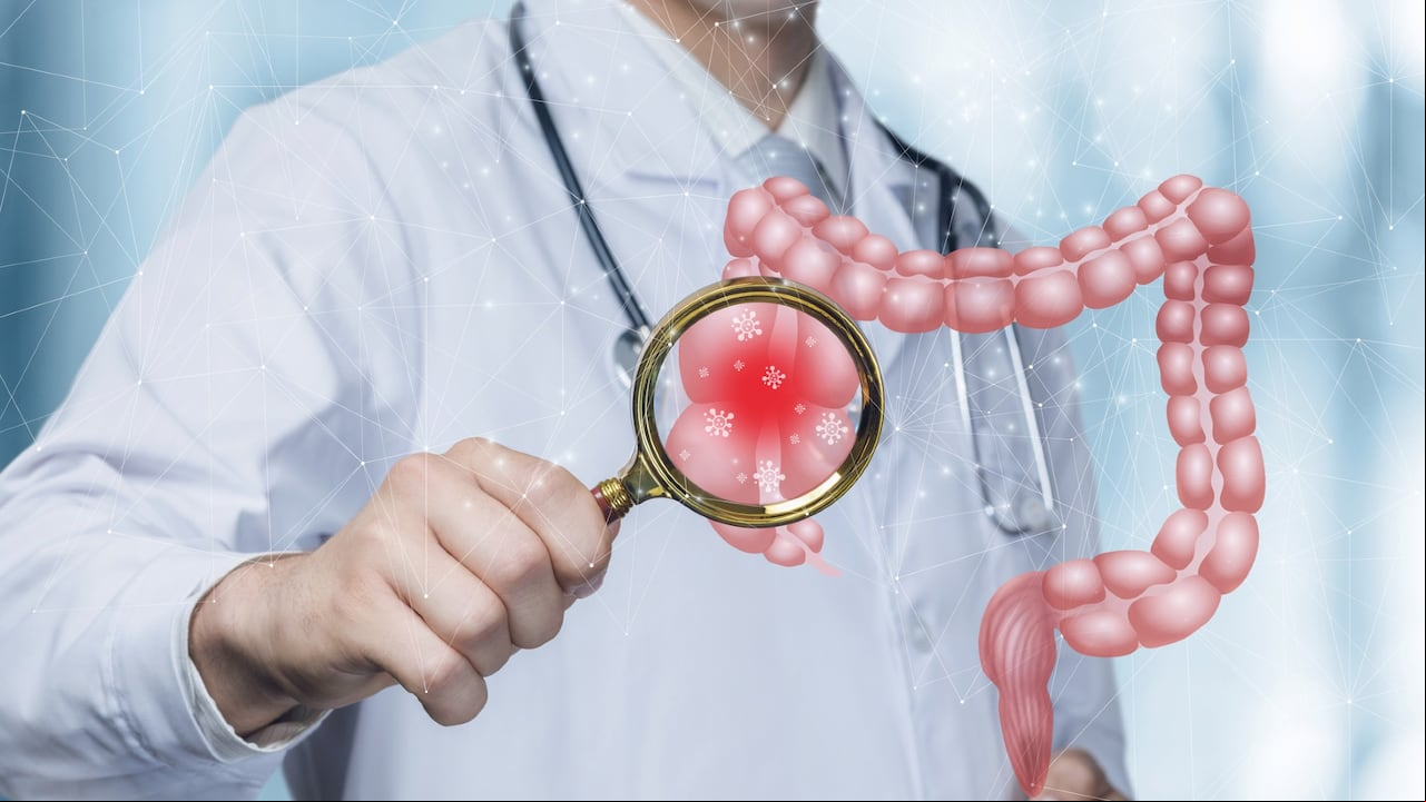 El síndrome de colon irritable es un trastorno frecuente que afecta el estómago y los intestinos.