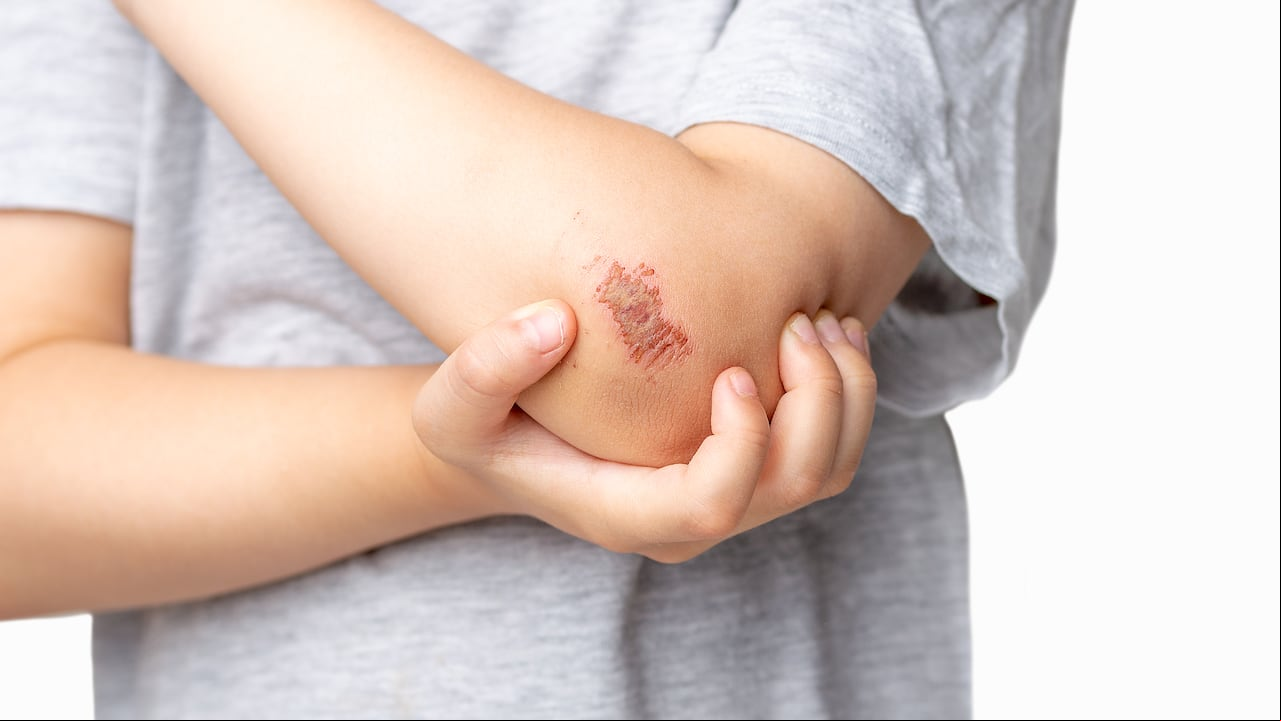 Heridas