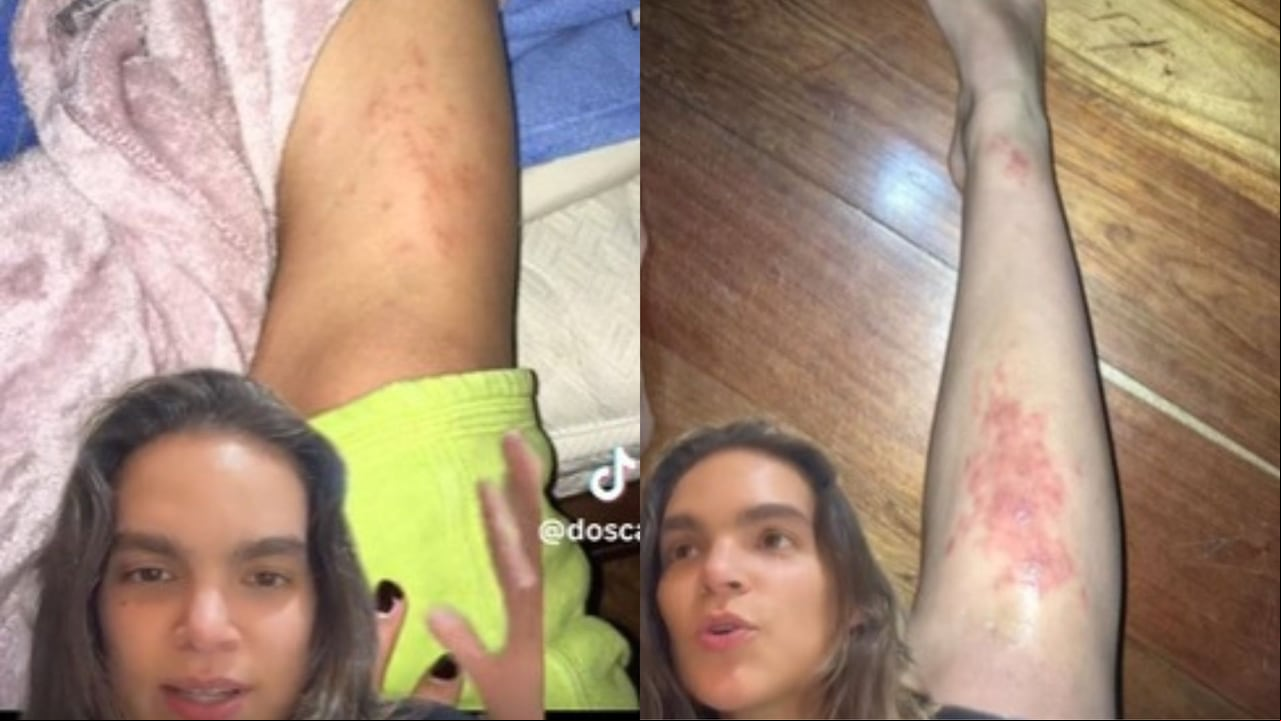 Muchos s en TikTok compartieron experiencias similares luego de que la joven contara que le dio un parásito.