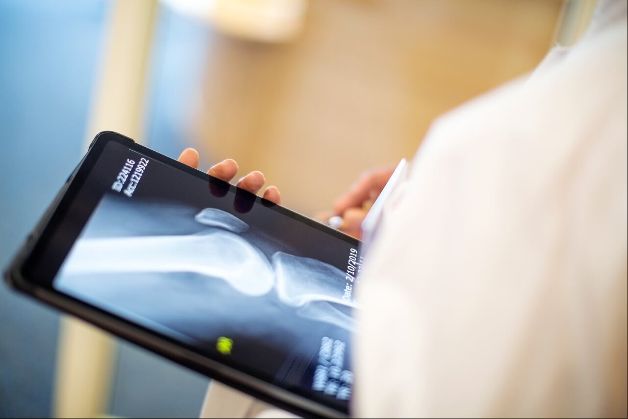 osteoporosis.