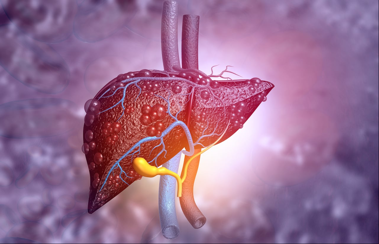 Estos síntomas podrían ser señal de cáncer de hígado.