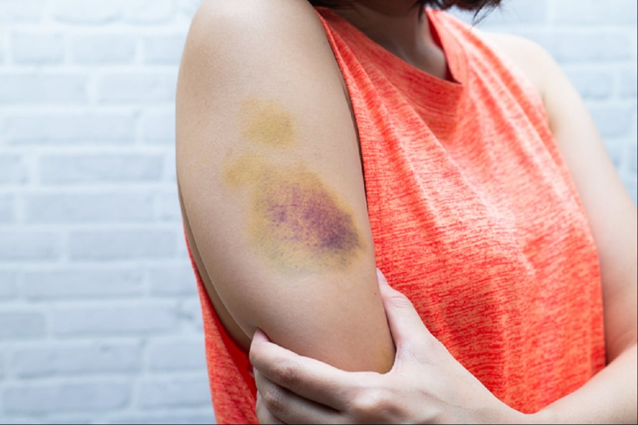 Hematoma
