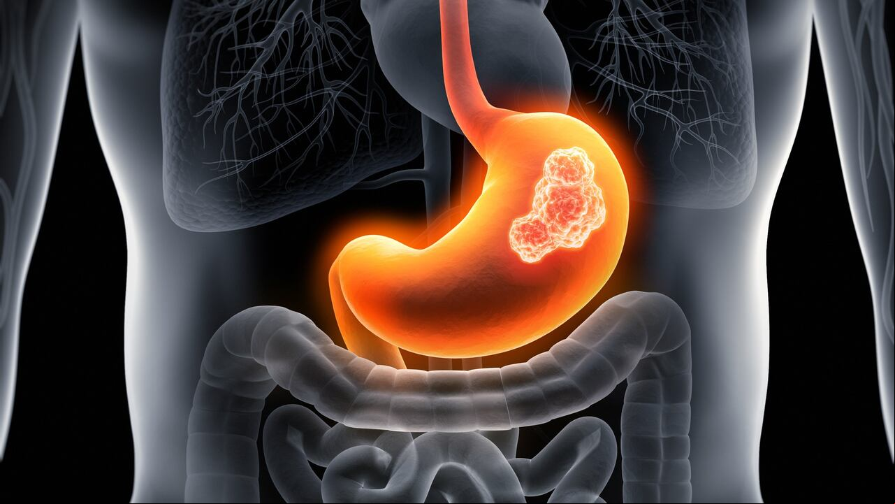 Cáncer de estómago
