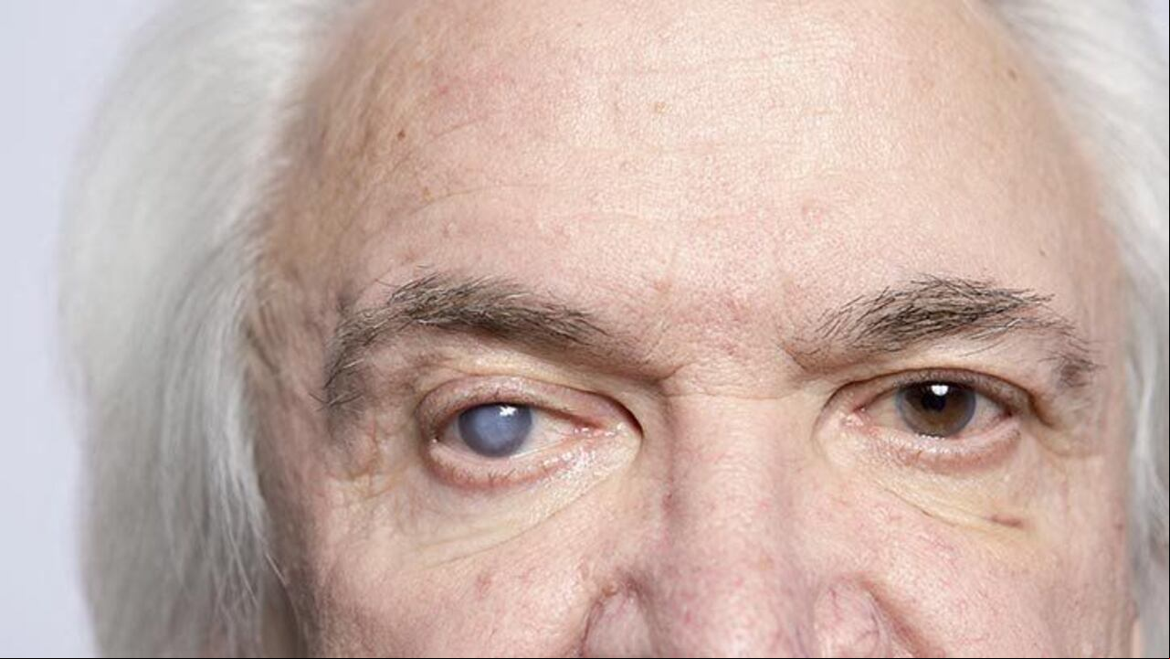 Una persona con una catarata en su ojo.