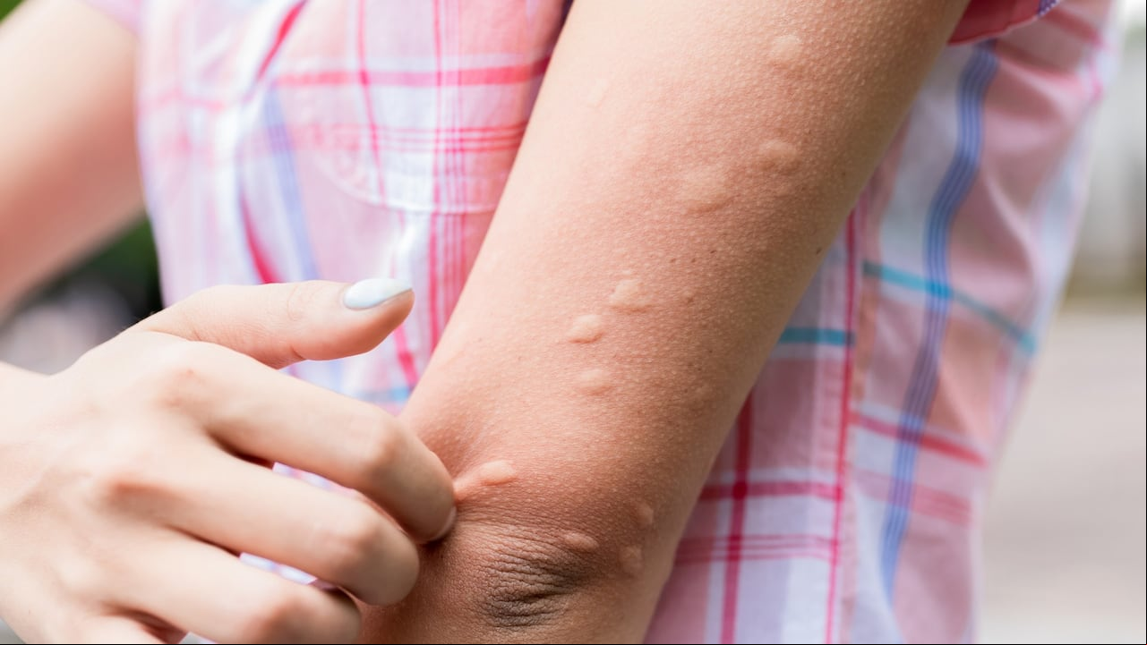 Una de las mejores formas de aliviar la picazón una vez ya nos han picado el mosquitos es aplicando el bicarbonato de sodio sobre la herida.