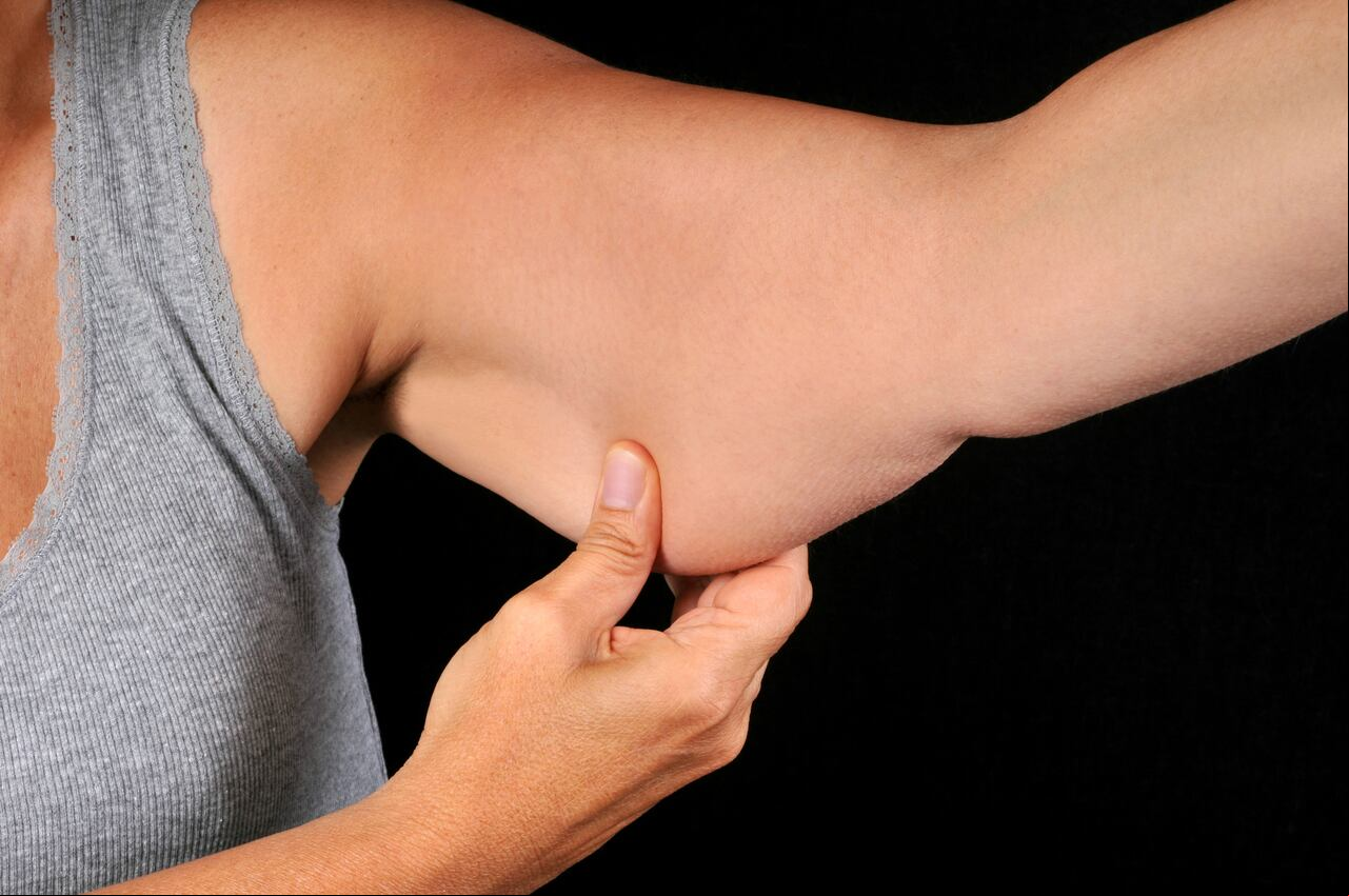 Brazo flácido