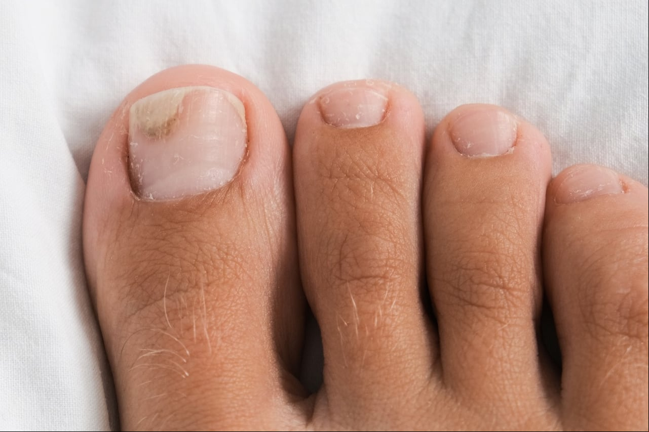 Hongos en uñas de los pies