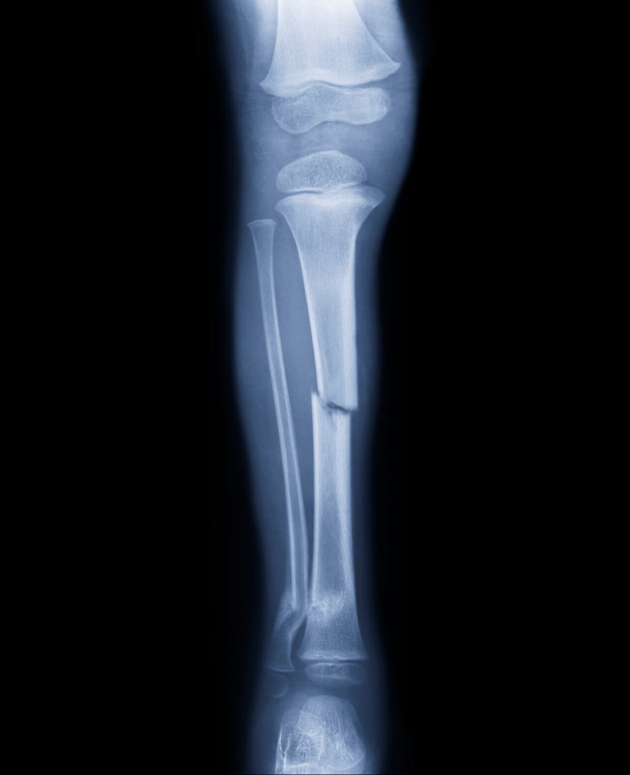Osteoporosis