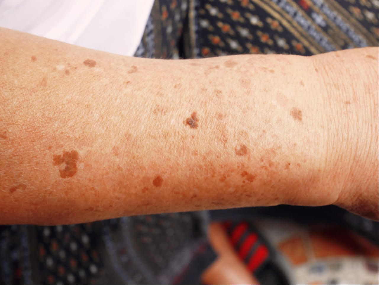 Las manchas de sol en las manos peuden ser producto de los rayos UV.