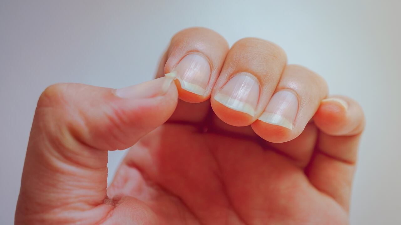 Uñas quebradizas