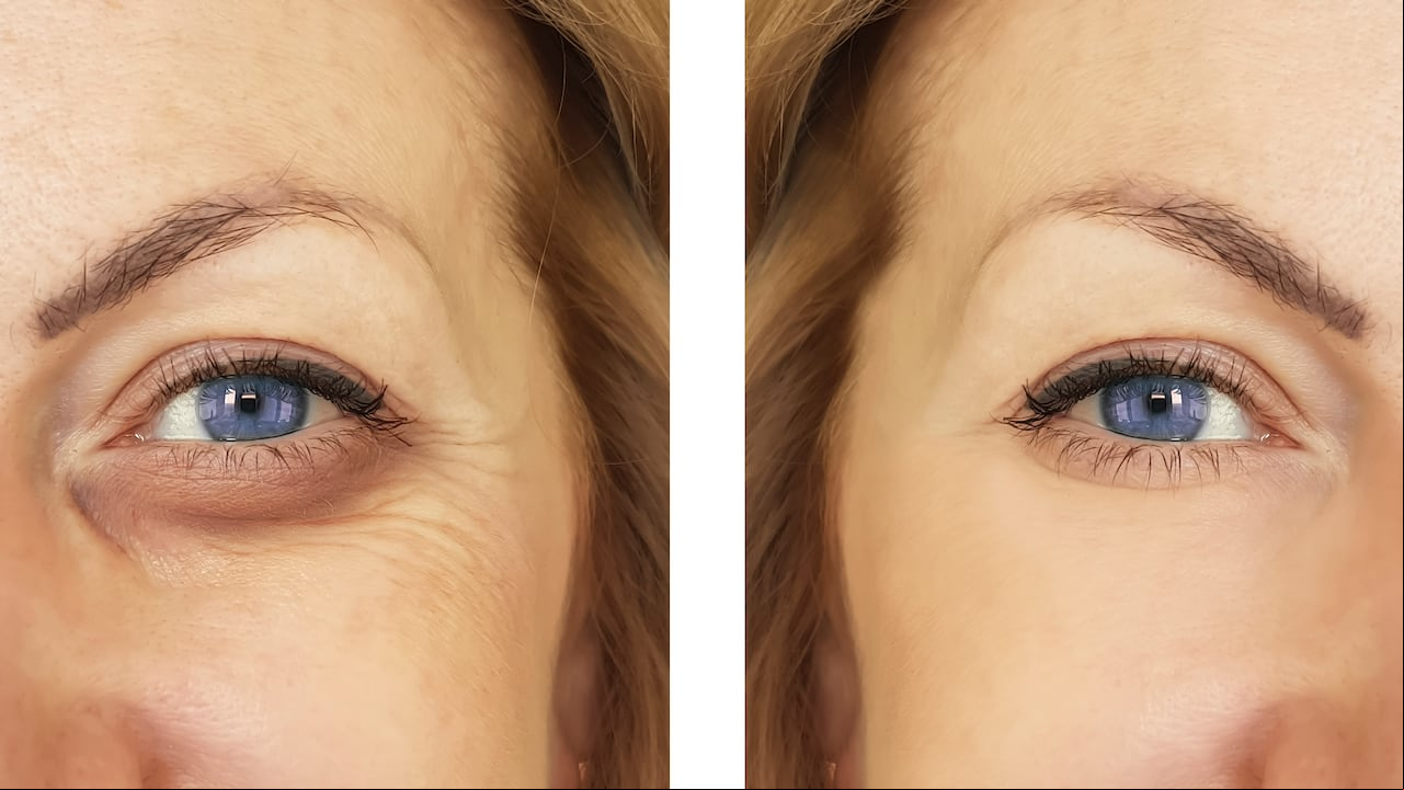 contorno de ojos