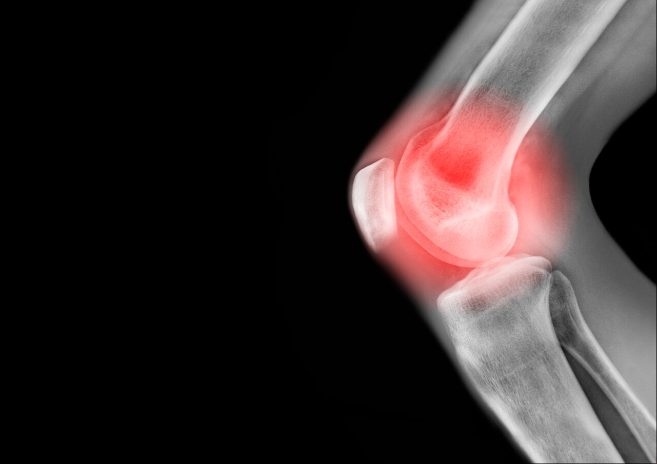 Radiografía de rodilla