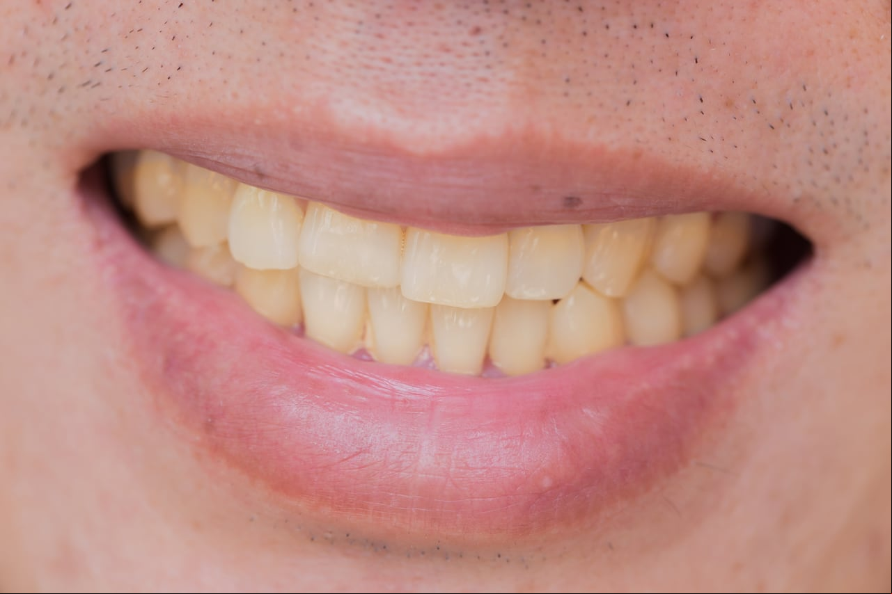 Los dientes cambian su color por el consumo de bebidas como el café.