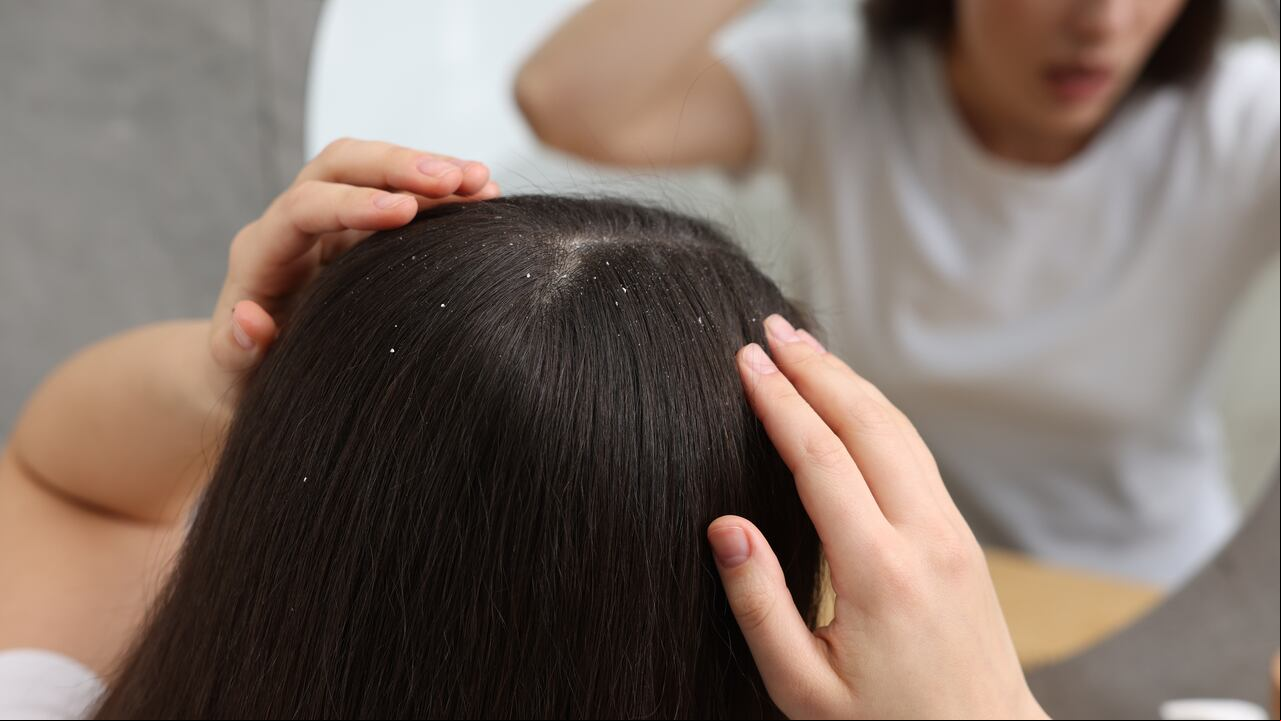 Descubra los beneficios ocultos de la canela y cómo puede ser la clave para un cuero cabelludo libre de caspa para sus lectores.