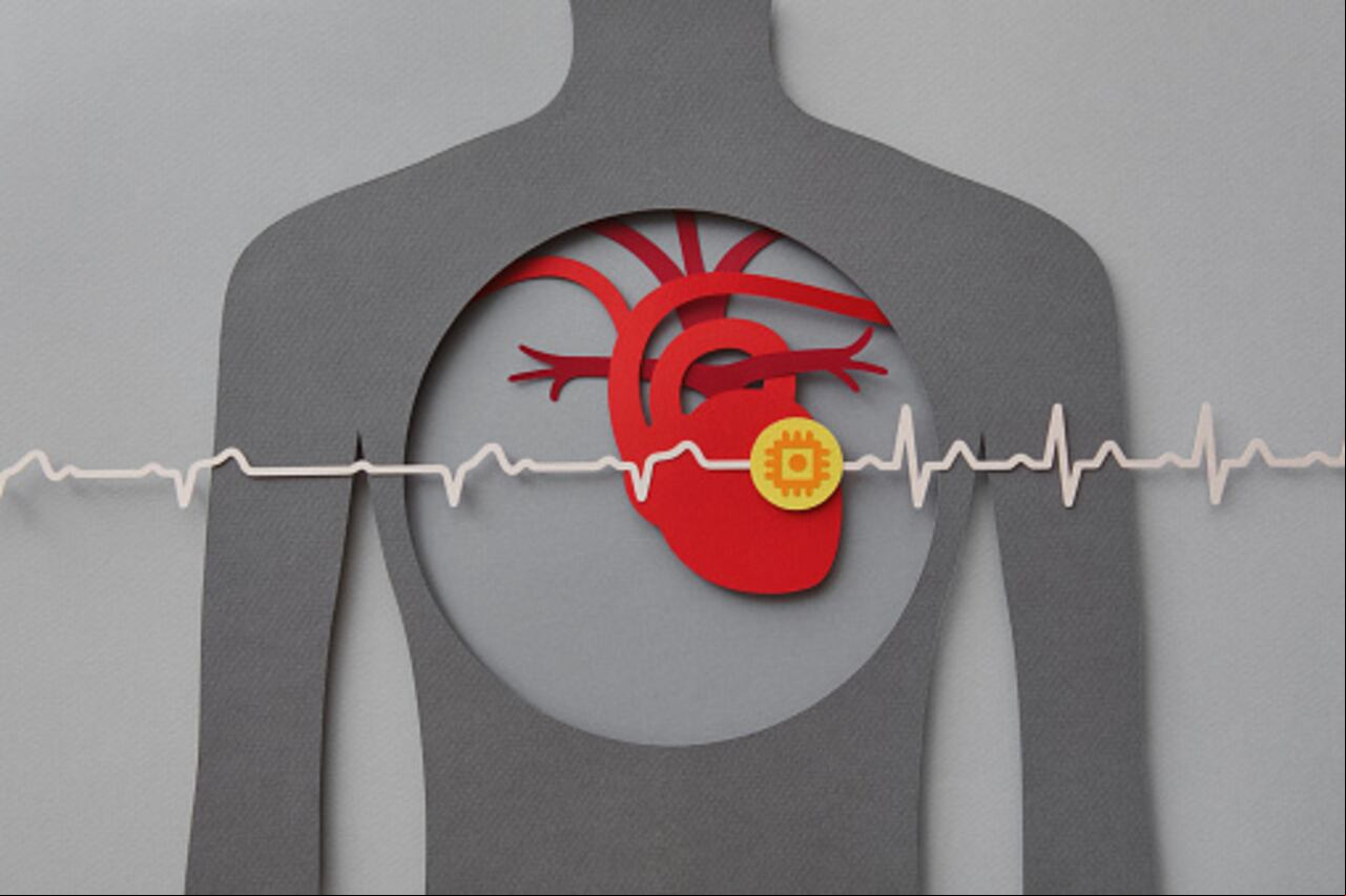 Este aparato detecta un latido cardiaco rápido y potencialmente mortal, el cual es denominado arritmia.