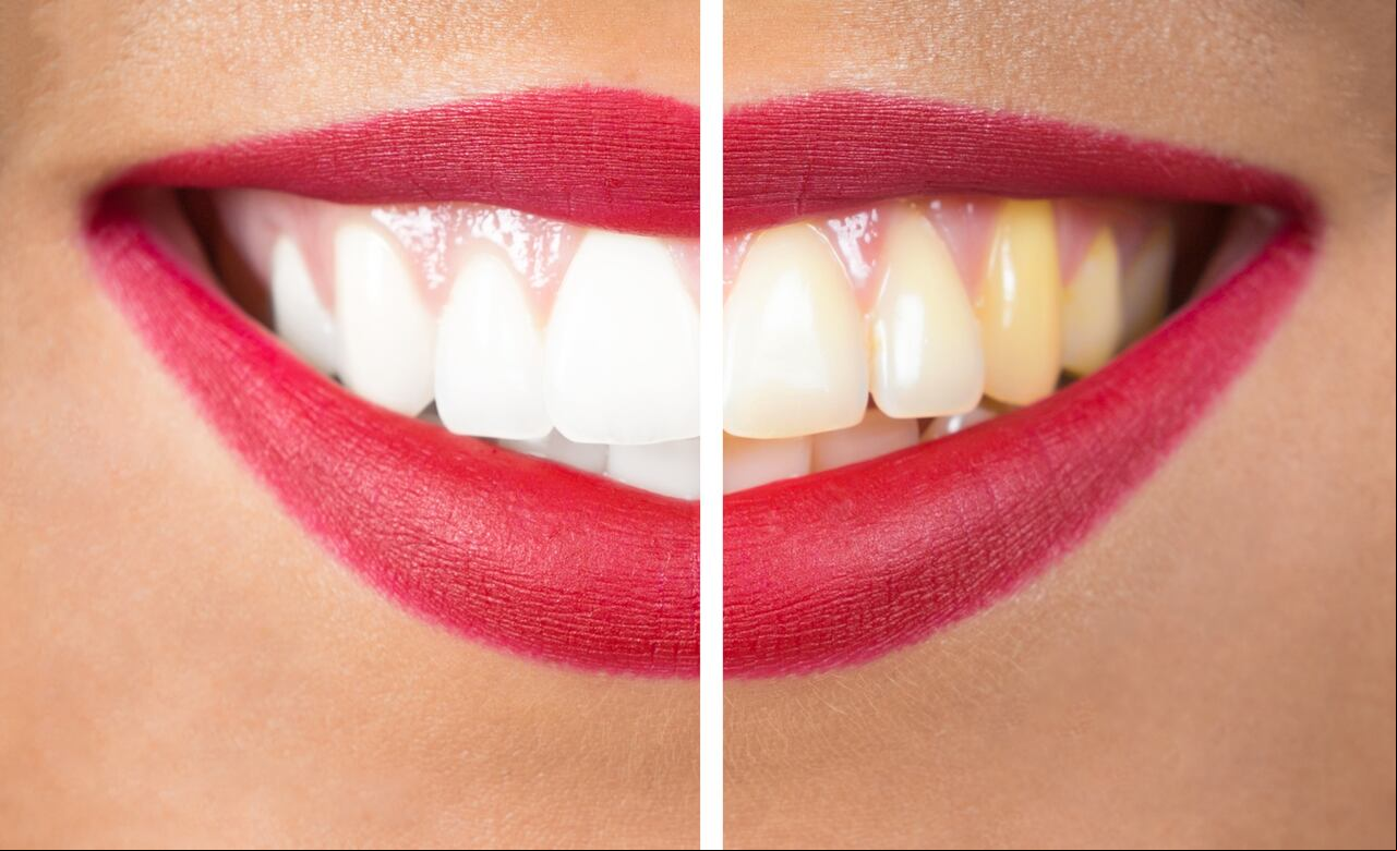 dientes amarillos