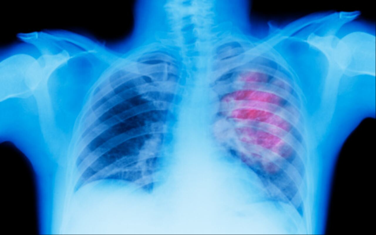 Existen varios tipos de cáncer que se pueden prevenir manteniendo buenos hábitos.