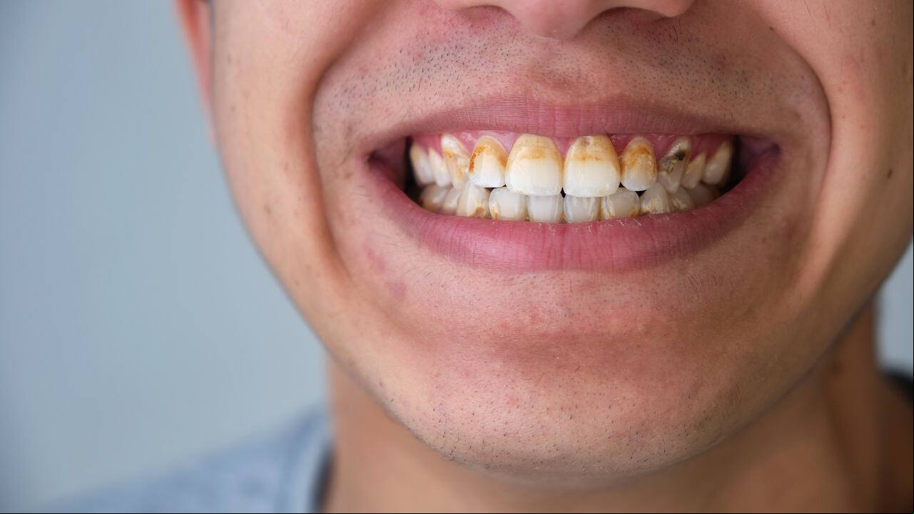Dientes - Sarro - Caries
