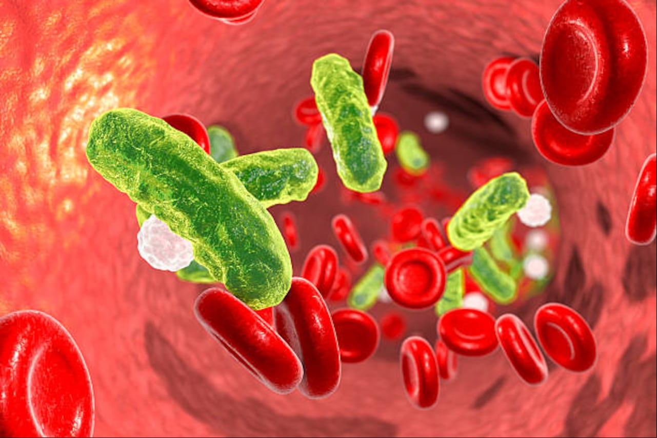 La Sepsis trae inflamación, alteraciones en la respiración y trastornos en el equilibrio del cuerpo que pueden llevar a la muerte de una persona.