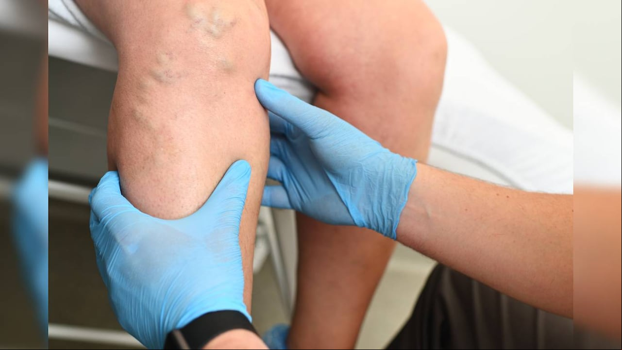 Las venas varicosas son venas retorcidas y agrandadas. Foto: Getty Images.