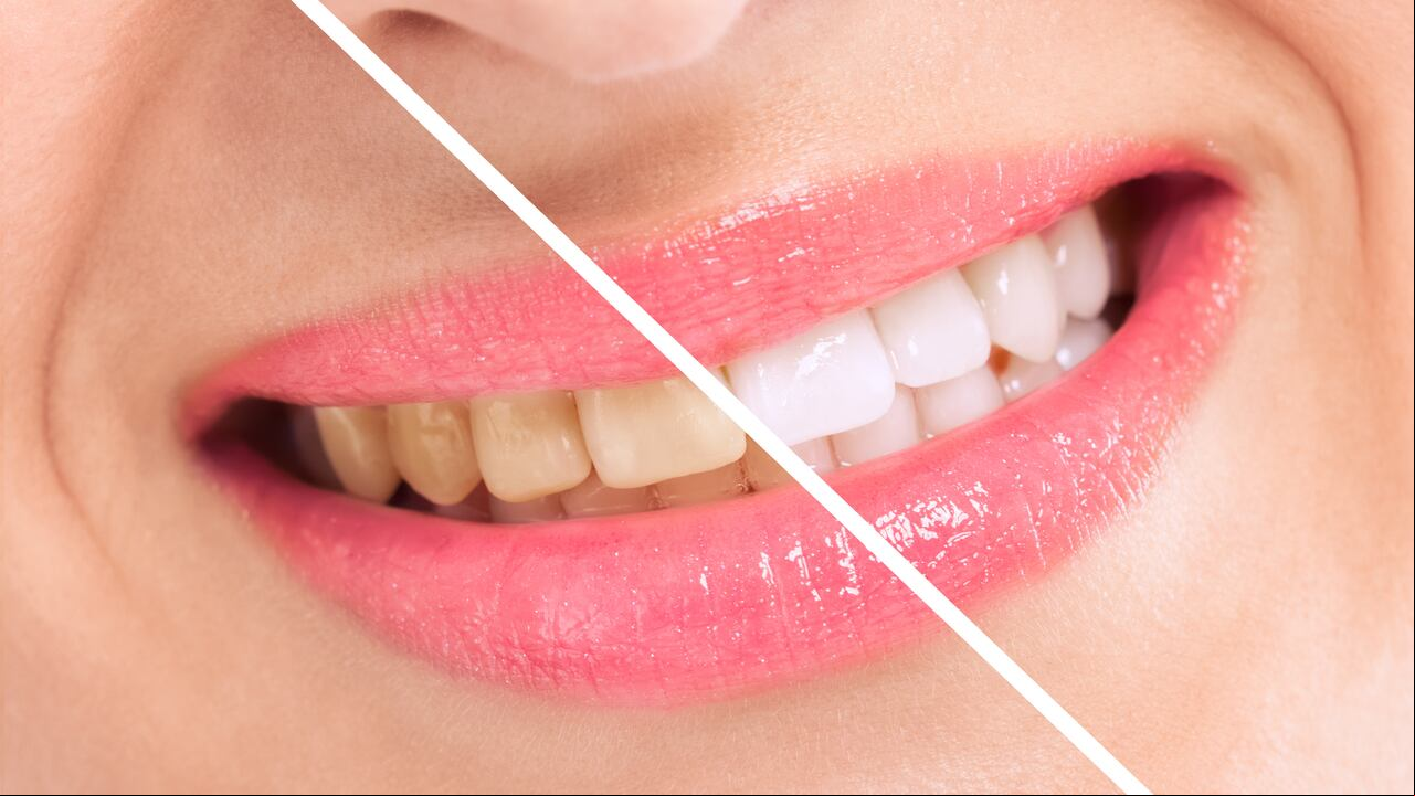 Dientes amarillos