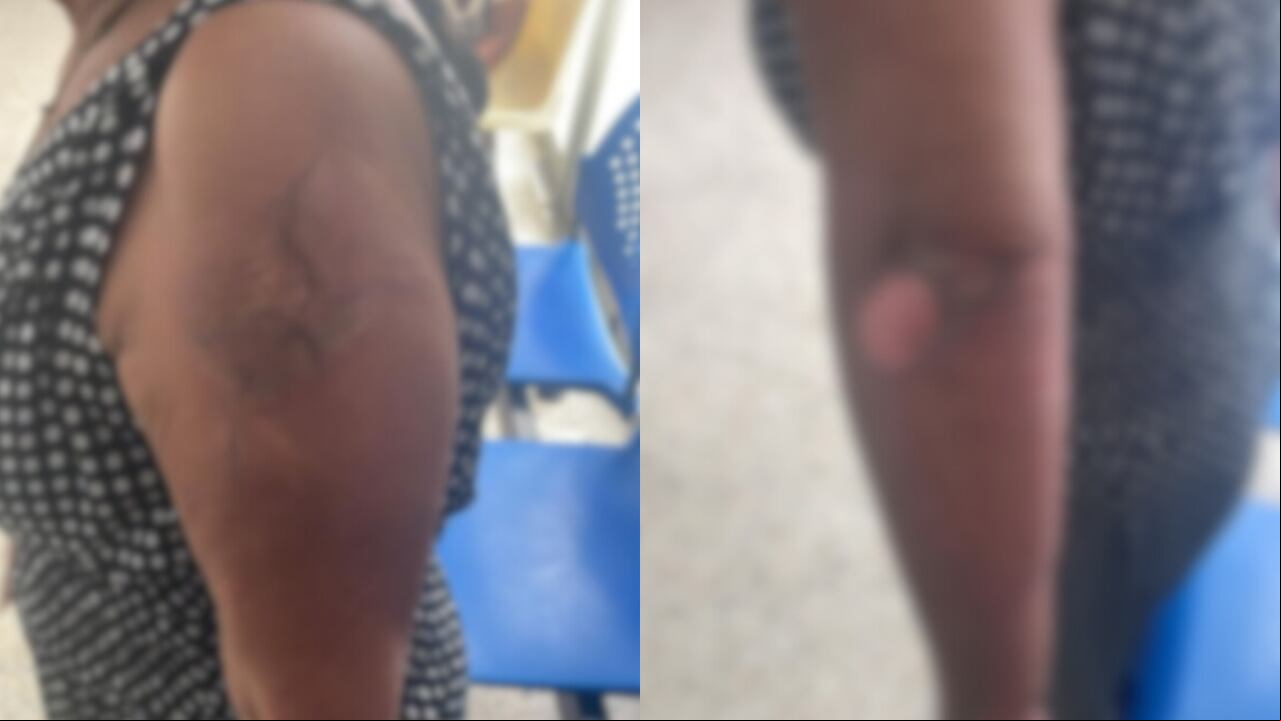 La mujer sufrió quemaduras de primer y segundo grado en gran parte del cuerpo.