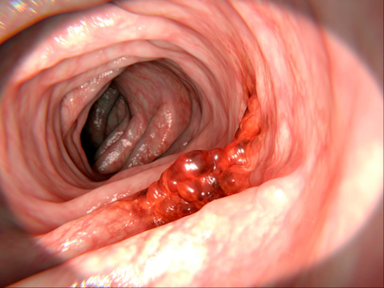 El cáncer de colon es una enfermedad común.