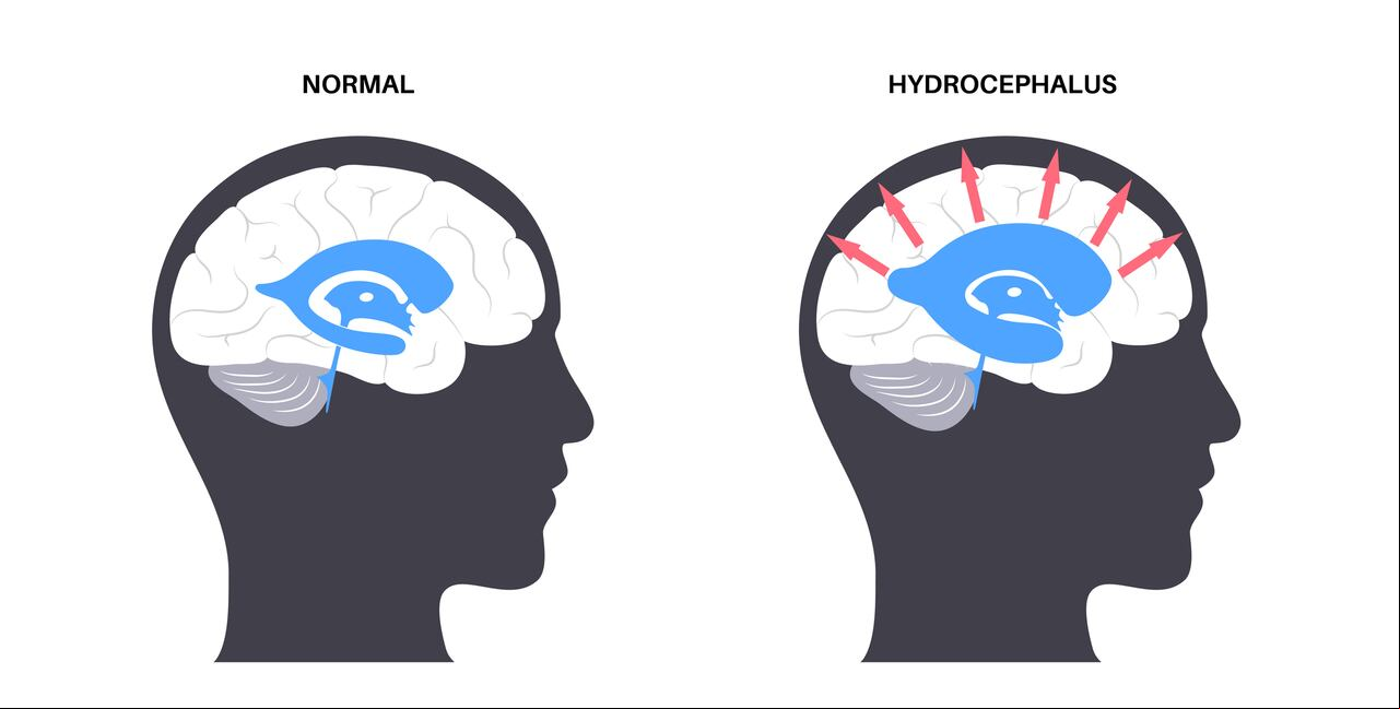 Concepto de derivación de hidrocefalia. Presión en el cartel del cerebro. Anatomía del sistema ventricular. Ventrículos cerebrales, producción, transporte y eliminación de líquido cefalorraquídeo. Ilustración de vector plano médico
