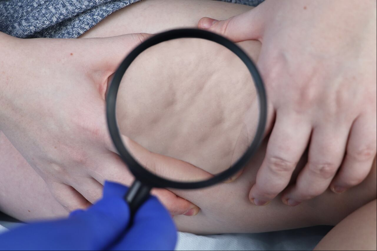 La celulitis se nota más con el sobrepeso.